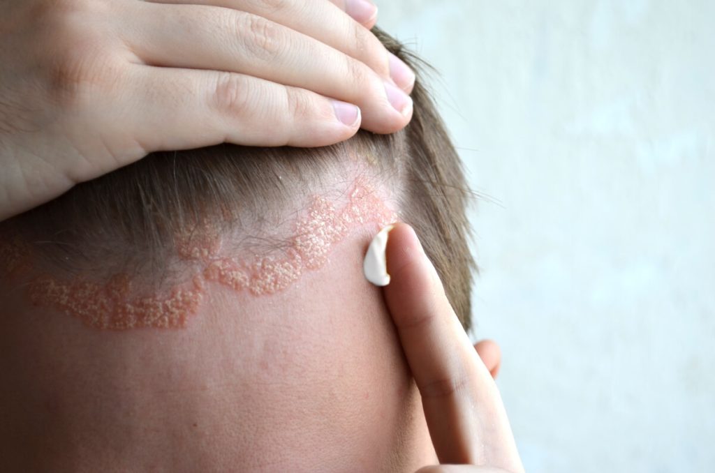 Czym jest łuszczyca skóry głowy – co to za choroba?