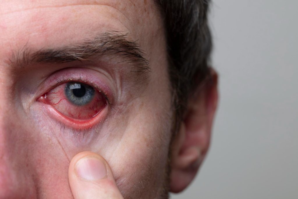 Przekrwione oczy i ból głowy: przyczyny, leczenie i objawy